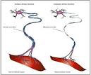 ALS, Lou Gehrigs Disease