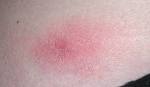 Treatment of <b>mycosis fungoides</b> using a 308-nm excimer laser: Two