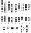 Down syndrome - Wikipedia, the free encyclopedia