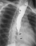 fibrosing <b>mediastinitis</b> in