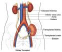 A patient with <b>kidney failure</b>