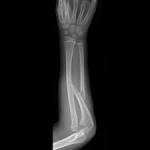 and type IV has a <b>fracture</b>