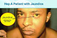 Hepatitis Symptoms Jaundice