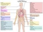 File:Cystic <b>fibrosis</b> manifestations.png - Wikimedia Commons