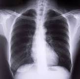 mesothelioma