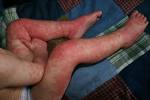 <b>Eczema</b> from detergents,