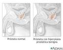 <b>Hiperplasia</b> es el incremento