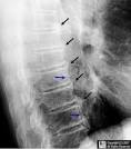 <b>Diffuse Idiopathic Skeletal</b>