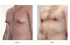 <b>gynecomastia</b> - case 2