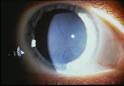 Corneal changes (2).jpg