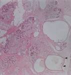Unusual Breast Lesions: Radiologic-Pathologic Correlation1