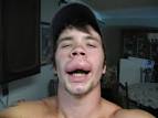 Bee sting allergic reaction