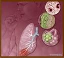 Un Medico En Casa.: INFECCION RESPIRATORIA AGUDA (