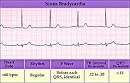 Bradycardia - Cardiac Health