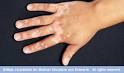 MayoCliniccom Health Library   Vitiligo