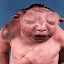 The EyePathologist - ANENCEPHALY - © Duke University