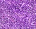 File:Carcinoma microcellulare oatcell carcinoma or anaplastic ...
