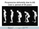 BASDAI Bath Ankylosing Spondylitis Disease Activity Index