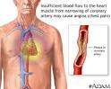 Stable <b>angina</b>