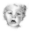 Fetal Alcohol <b>Syndrome</b>