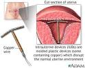 Birth control options for women - Intrauterine Devices (
