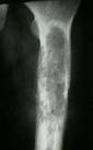 <b>Fibrous Dysplasia</b>: