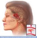 MayoClinic.com Health Library - Brain aneurysm