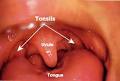 Tonsils Removal with Radio Frequency - Health Net