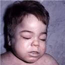 The EyePathologist - Mucopolysaccharidosis type II - © Duke University