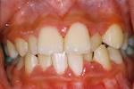 <b>Periodontal</b> (Gum) <b>Disease</b> - Institute of Dental Implants