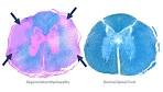 Degenerative Myelopathy - disease basics
