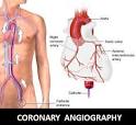 Coronary <b>Angiography</b> Procedure