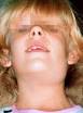 <b>parotitis</b> of chil