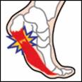 How to Heal and Prevent Plantar Fasciitis (Bruised Heel) - Yahoo ...