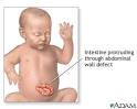 <b>Gastroschisis</b> is rarely