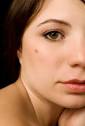 Malignant melanoma is a