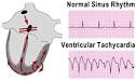 Ventricular <b>Tachycardia</b>