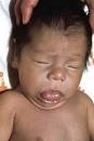 Baby Hypothyroidism | About Child