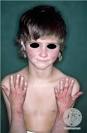 <b>Rothmund</b>-<b>Thomson Syndrome</b>