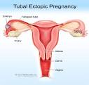 Ectopic Pregnancy Symptoms, Treatment, Diagnosis - eMedicineHealth