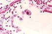 Cytomegalovirus - Wikipedia, the free encyclopedia