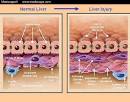 Stellate cell activation leads