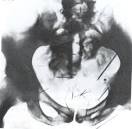 X-RAY of Albert Fish - Awesome Stories