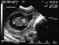 <b>ABORTO RETENIDO</b> CON FETOS