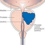 Prostate cancer - Wikipedia, the free encyclopedia