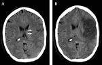 <b>middle cerebral artery</b>