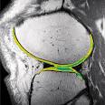 ACL Tears  MRI Reveals Long Term Impact   HSSedu   HSS