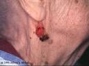 Squamous Cell Carcinoma near the earlobe