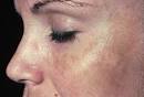 Photo of melasma (pregnancy