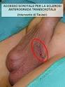 <b>IPOSPADIA</b> - VARICOCELE